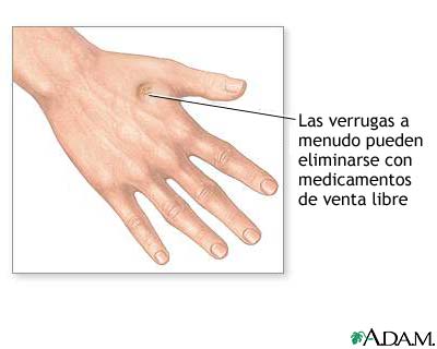 Eliminaci&oacute;n de verrugas