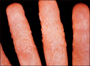 Dermatitis como reacci&oacute;n a la ti&ntilde;a