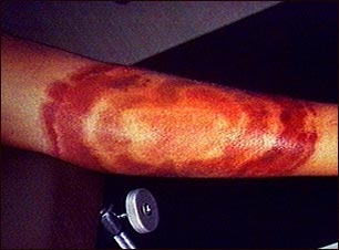 Eritema cr&oacute;nico migratorio en la enfermedad de Lyme