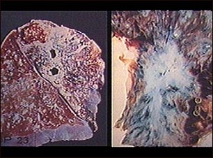 Tuberculosis pulmonar