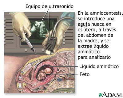 Amniocentesis