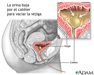 Cateterizaci&oacute;n de la vejiga en la mujer