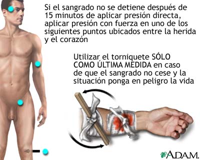 Interrupci&oacute;n de sangrado con torniquete