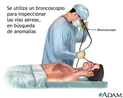 Broncoscopia