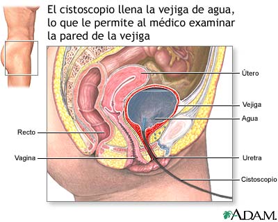 Cistoscopia