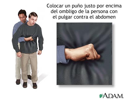 Maniobra de Heimlich en el adulto