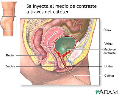 Cistouretrograma de eliminaci&oacute;n