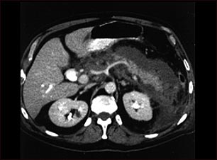 Pancreatitis aguda; TC