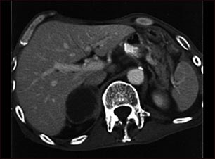 Met&aacute;stasis suprarrenal -TC
