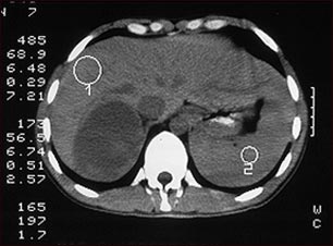 Tumor suprarrenal, tomograf&iacute;a computarizada