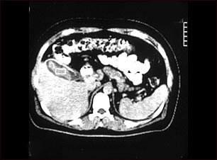 Tomograf&iacute;a computarizada de una colecistitis