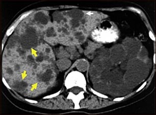Quistes del ri&ntilde;&oacute;n y el h&iacute;gado; TC
