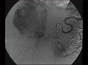 Angiograma de hemangioma