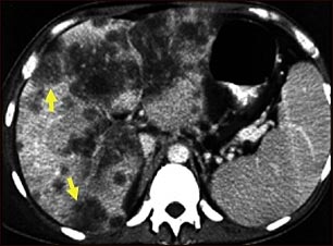 C&aacute;ncer hepatocelular, TC