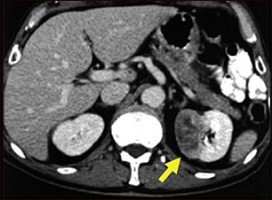 TC de tumor del ri&ntilde;&oacute;n