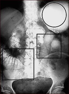 Ileo: Radiograf&iacute;a del est&oacute;mago e intestino distendido