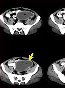 Absceso intraabdominal-TC