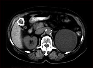 Quiste renal con c&aacute;lculos biliares; TC