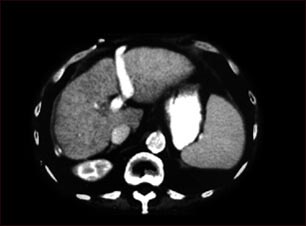 Cirrosis hep&aacute;tica; TC