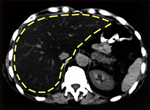 TC de grasa del h&iacute;gado