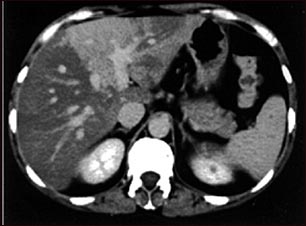 TC de h&iacute;gado con exceso de grasa