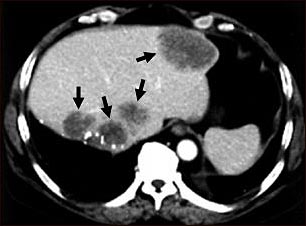 TC de met&aacute;stasis hep&aacute;tica