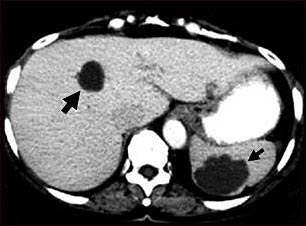 TC de quistes del h&iacute;gado y el bazo