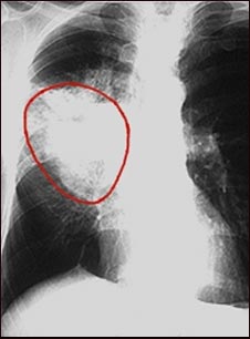 C&aacute;ncer de pulm&oacute;n -Radiograf&iacute;a frontal del t&oacute;rax
