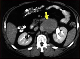 Tomograf&iacute;a computarizada de met&aacute;stasis a los ganglios linf&aacute;ticos