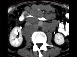 Linfoma maligno - TC