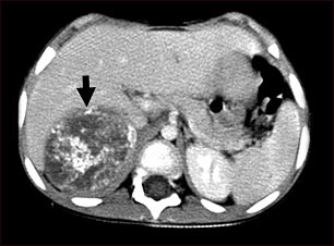 Tomograf&iacute;a computarizada de neuroblastoma en el h&iacute;gado
