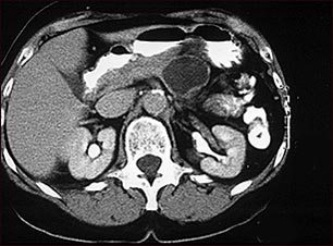 Adenoma qu&iacute;stico del p&aacute;ncreas; TC