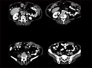 TC de c&aacute;ncer peritoneal y de ovario