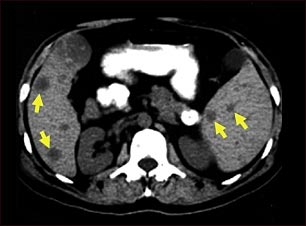 Tomograf&iacute;a computarizada de met&aacute;stasis del bazo