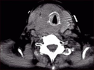 Tomograf&iacute;a computarizada de c&aacute;ncer de tiroides