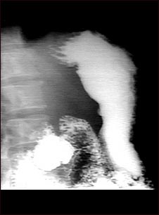 Radiograf&iacute;a de &uacute;lcera estomacal