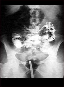 Radiograf&iacute;a de v&oacute;lvulo