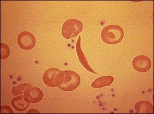 Gl&oacute;bulos rojos drepanoc&iacute;ticos