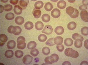 Malaria, vista microsc&oacute;pica de par&aacute;sitos celulares