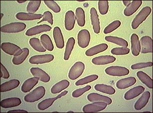 Gl&oacute;bulos rojos con eliptocitosis