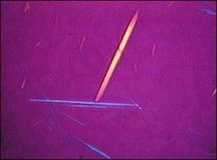 Cristales de &aacute;cido &uacute;rico