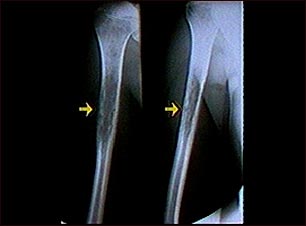 Rayos X de un sarcoma de Ewing