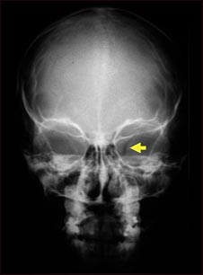 Neurofibromatosis I, agrandamiento de la abertura &oacute;ptica