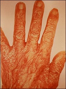 Erupci&oacute;n y excoriaci&oacute;n en la mano por sarna