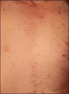 Lesiones en el t&oacute;rax por varicela