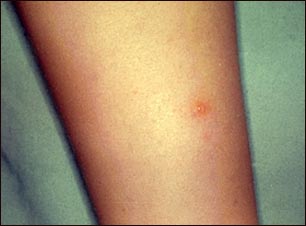 Varicela - Lesi&oacute;n en la pierna