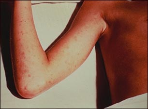 Fiebre maculosa de las Monta&ntilde;as Rocosas en la mano