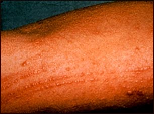 Erupci&oacute;n por roble venenoso en el brazo