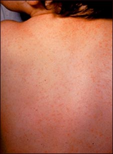 Echovirus tipo 9- Exantema