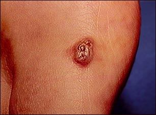 Sarcoma de Kaposi- lesi&oacute;n en la piel